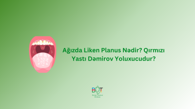 Ağızda Liken Planus Nədir? Qırmızı Yastı Dəmirov Yoluxucudur?