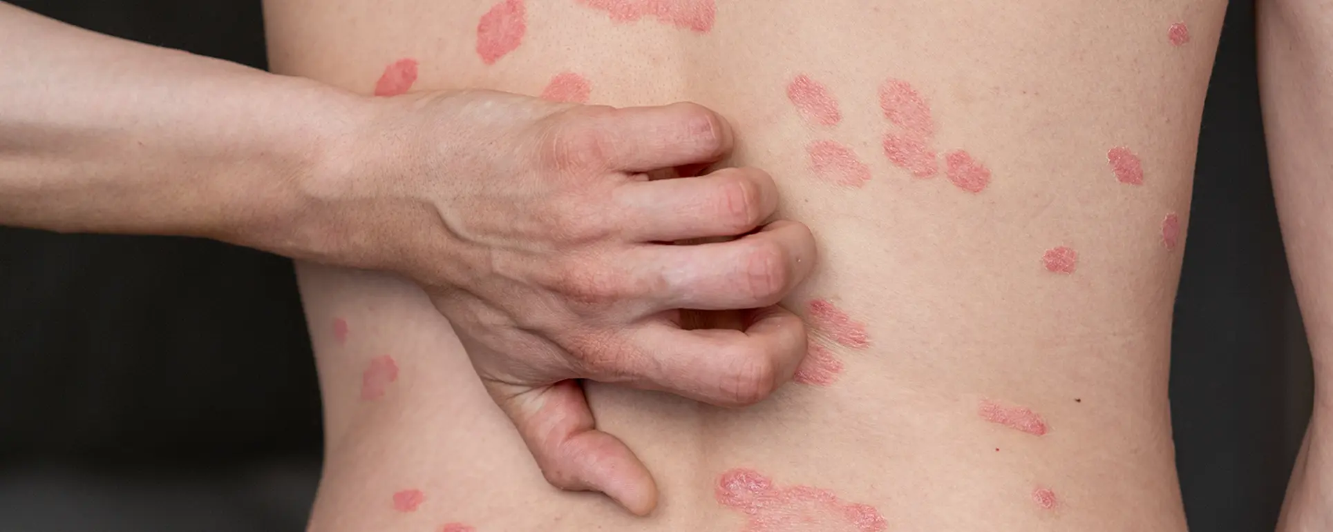 Dəmrov Xəstəliyi Necə Müalicə Olunur? Növləri Nələrdir?